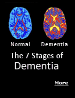 Dementia is marked by a severe decline in cognitive functions, such as thinking, reasoning, and remembering, to the extent that it interferes with the person's daily life.